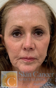 Fraxel and Filler-before