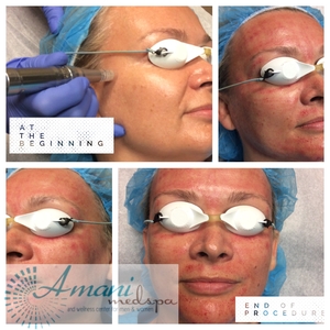 Right after treatment & 1 day after-before