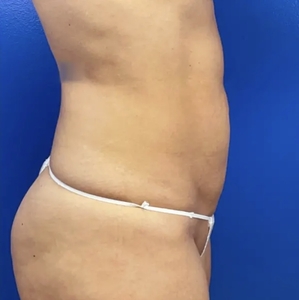 Lipo w Renuvion #5-after
