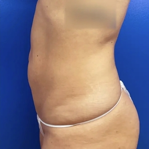 Lipo w Renuvion #5-after