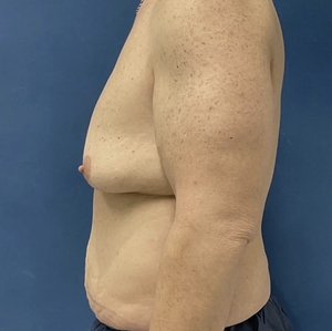 Male Breast Reduction #6 (left)-before
