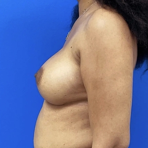 Breast Augmentation #14 325/350 cc-after