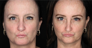 chotox - 20u gl, 10 u fh, 24u CF, 6u lips, 6u mentalis-before