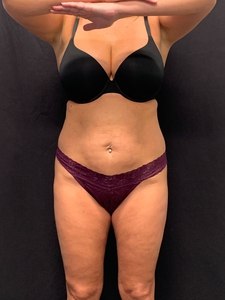 LAL upper+ lower abdomen + mini tummy tuck-after