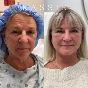 Revision Face & Neck Lift and CO2 Laser-before