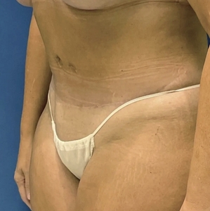 Tummy Tuck #8 (left olbique)-after