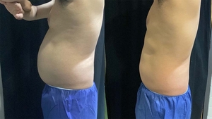coolsculpting+cooltone-12-treatments-before