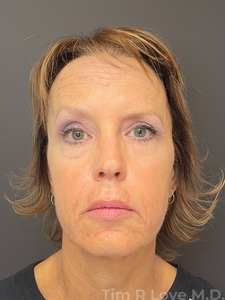 11 months post Morpheus8/Nanofat x3, Sculptra, 1 syringe Versa filler-after