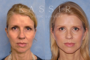 Designer Face Lift Before and After-before