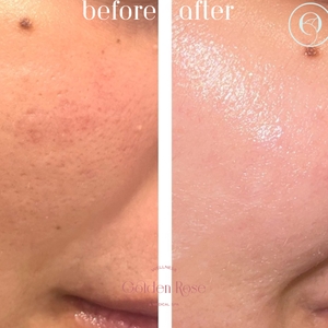Microneedling-before