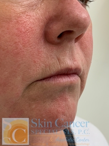 lip filler-before