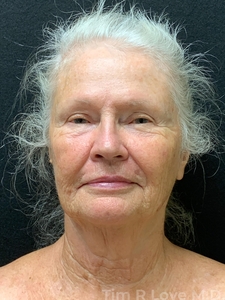 Facial Rejuvenation-before