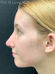 2 Weeks Post Op-after