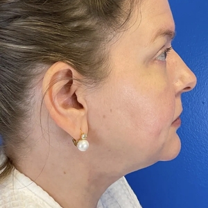 Lipo w Skin Tightening Face #8-after