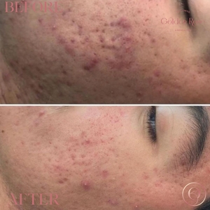Acne/ acne scars-before