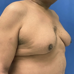 Male Breast Reduction #2-before
