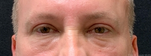 1 month post upper blepharoplasty-after