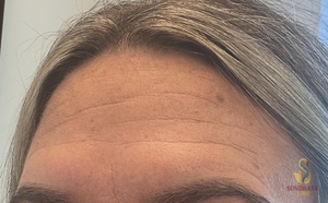 Nouvaderm Laser Treatment-Forehead-24 hours Post Treatment-after