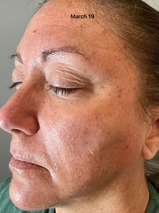 age spots/telang-before