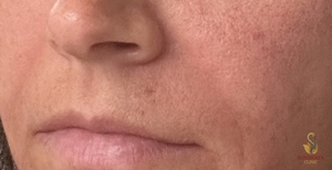 Nouvaderm Laser Treatment- Cheeks-24 hours Post Treatment-before