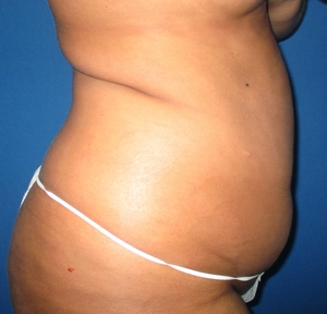 Liposuction #1-before