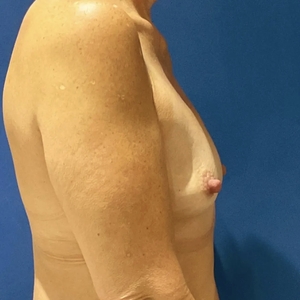 Breast Augmentation #5 350 cc-before
