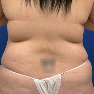 Tummy Tuck #6-after