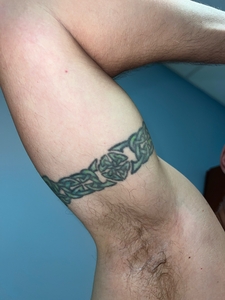 Tatto rmoval arm before-before