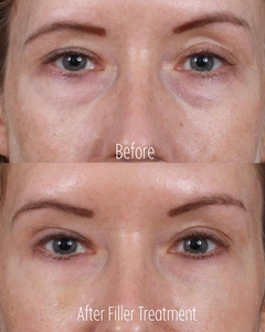 Filler B/A SBA 24-before