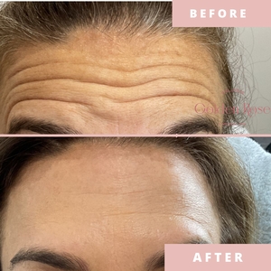 Neuromodulators-before