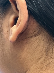 Keloid on ear-before