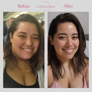 Medical Assisted WeightLoss-before