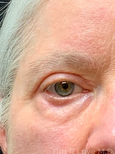 with lower lid Morpheus/Fractora-after