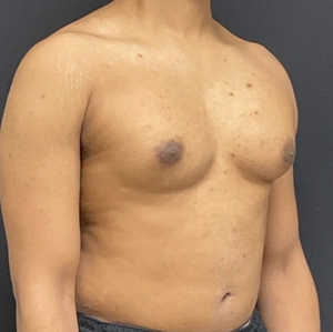 Male Breast Reduction #8-before