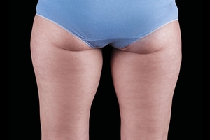 4 Treatments-after