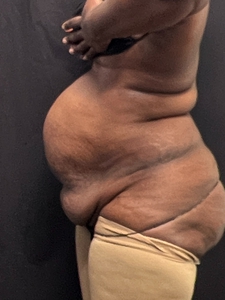 Tummy Tuck w/ plication + liposuction-low back + waist-after