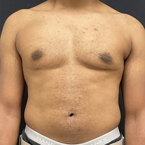 Male Breast Reduction #8-after