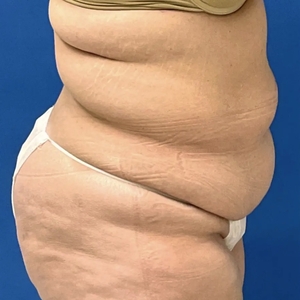 Tummy Tuck #14-before