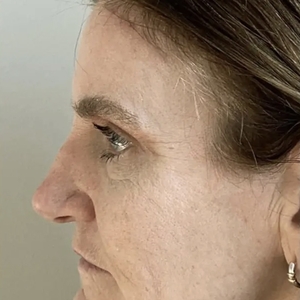 Brow & Eye Lift #1-after