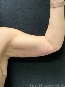 Brachioplasty-after