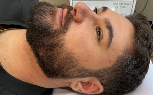 Michael B&A SkinPen-before