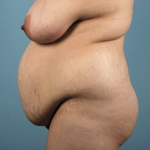 Mommy Makeover #4-before