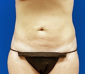 Liposuction #2-after