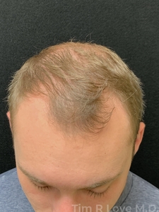 27 year old male after 1 year on Finasteride, no transplant needed-before