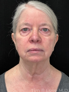 MyEllevate with Upper Bleph-before