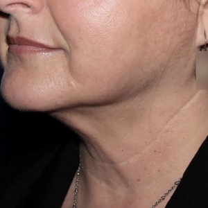 Lipo w Skin Tightening Face #5-after