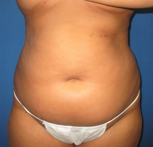 Liposuction #1-before