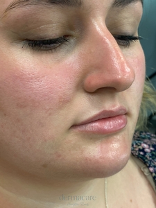 Whitney Devall RN. Versa-before