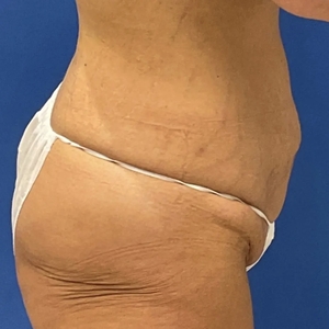 Tummy Tuck #3-before