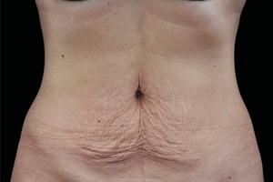 4 Treatments-before